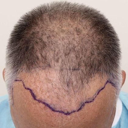 Hair Transplant - Male: Frontal FUE - Case 24 - Before FUE hair transplant