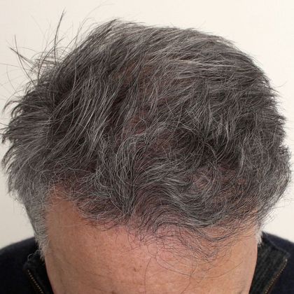 Hair Transplant - Male: Frontal FUE - Case 24 - After FUE hair transplant
