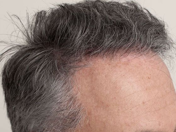 Male Before And After Hair Transplant Photos Frontal FUE - After