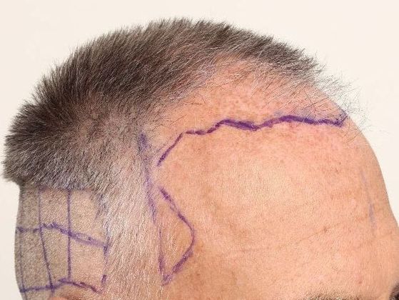Male Before And After Hair Transplant Photos Frontal FUE - Before