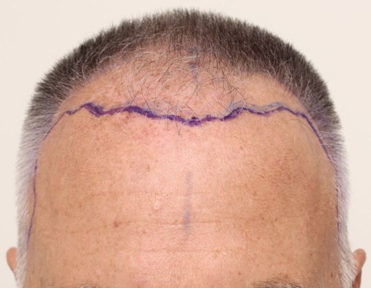 Hair Transplant - Male: Frontal FUE - Case 24 - Before FUE hair transplant