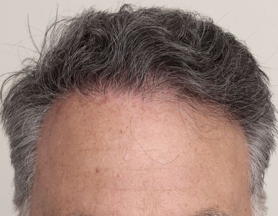 Hair Transplant - Male: Frontal FUE - Case 24 - After FUE hair transplant