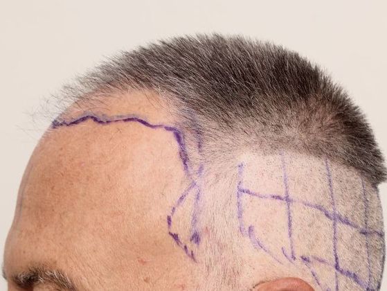 Hair Transplant - Male: Frontal FUE - Case 24 - Before FUE hair transplant