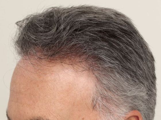 Hair Transplant - Male: Frontal FUE - Case 24 - After FUE hair transplant
