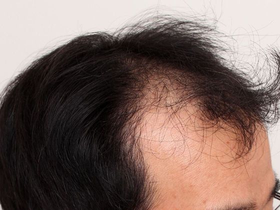 Male Before And After Hair Transplant Photos Frontal FUT (3) - Before