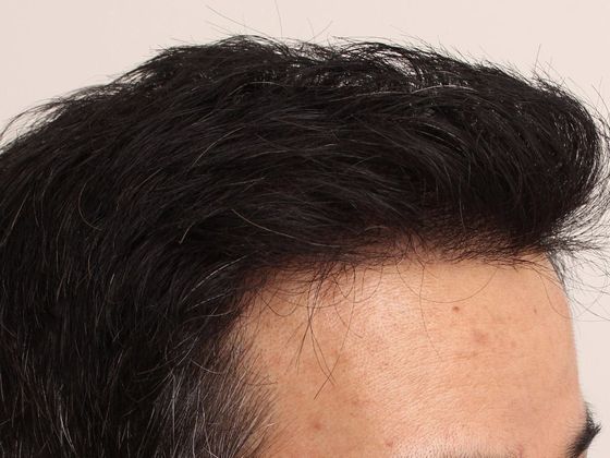 Male Before And After Hair Transplant Photos Frontal FUT (3) - After
