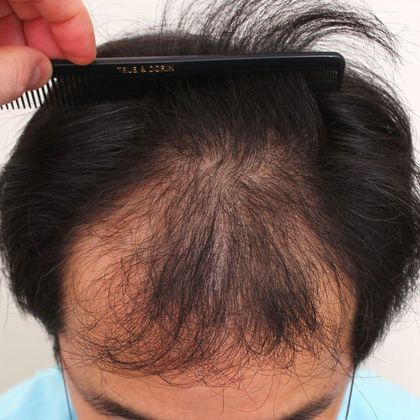Hair Transplant - Male: Frontal FUT - Case 42 - Before FUT hair transplant