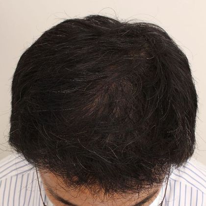 Hair Transplant - Male: Frontal FUT - Case 42 - After FUT hair transplant