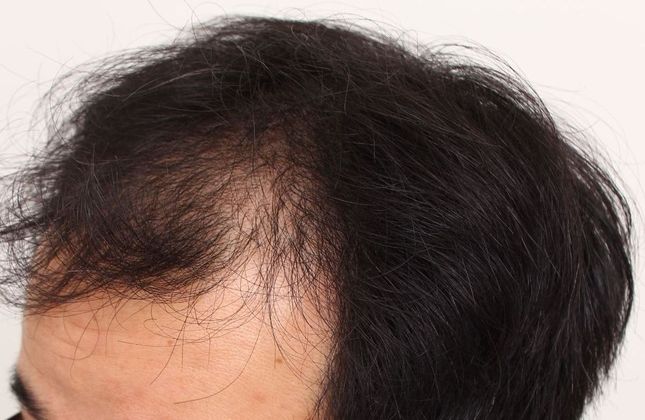 Hair Transplant - Male: Frontal FUT - Case 42 - Before FUT hair transplant