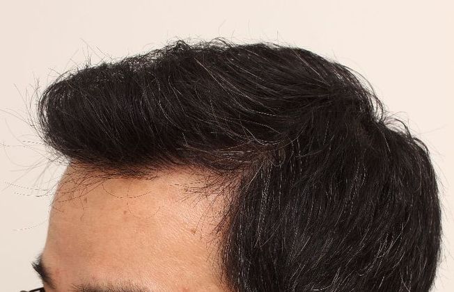 Hair Transplant - Male: Frontal FUT - Case 42 - After FUT hair transplant