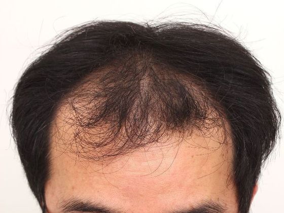 Hair Transplant - Male: Frontal FUT - Case 42 - Before FUT hair transplant