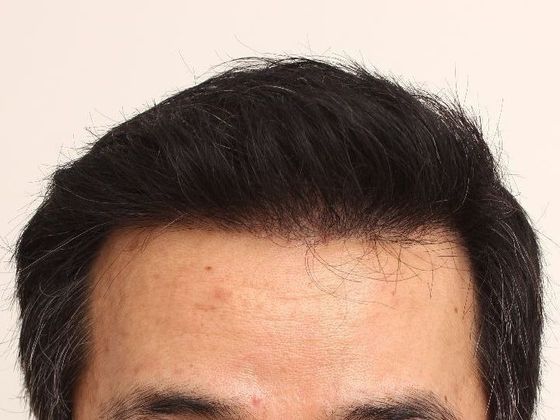 Hair Transplant - Male: Frontal FUT - Case 42 - After FUT hair transplant