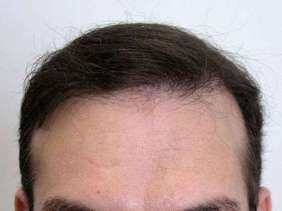 Hair Transplant - Male: Front & Top FUT - Case 48 - After FUT hair transplant