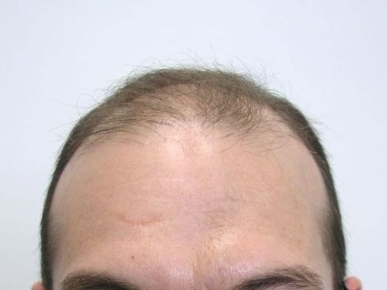Hair Transplant - Male: Front & Top FUT - Case 48 - Before FUT hair transplant