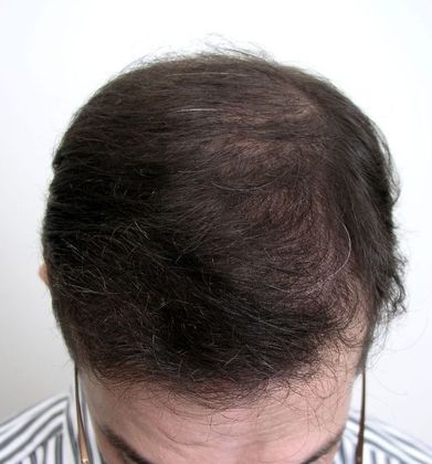 Hair Transplant - Male: Front & Top FUT - Case 48 - After FUT hair transplant