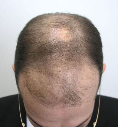 Hair Transplant - Male: Front & Top FUT - Case 48 - Before FUT hair transplant