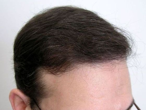 Male Before And After Hair Transplant Photos Front & Top FUT (3) - After