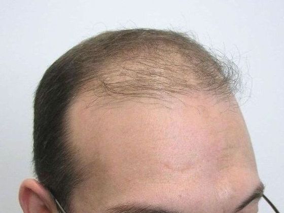 Male Before And After Hair Transplant Photos Front & Top FUT (3) - Before