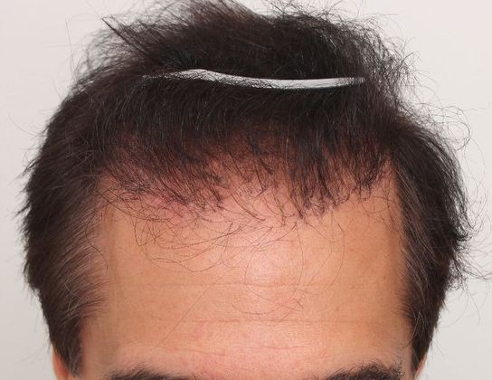 Hair Transplant - Male: Hair Transplant Repair - Case 52 - Bad hair transplant before