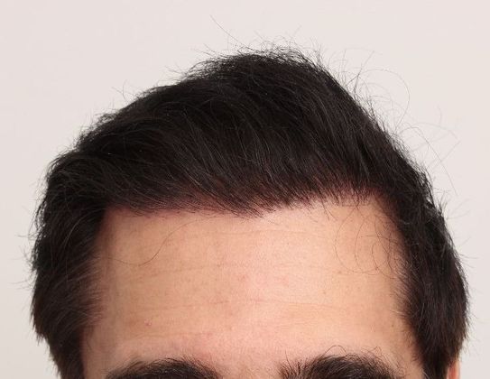 Hair Transplant - Male: Hair Transplant Repair - Case 52 - Hair transplant revised after ultra-refined FUT