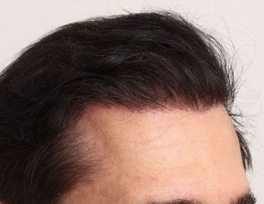 Male Before And After Hair Transplant Photos Hair Transplant Repair (2) - After
