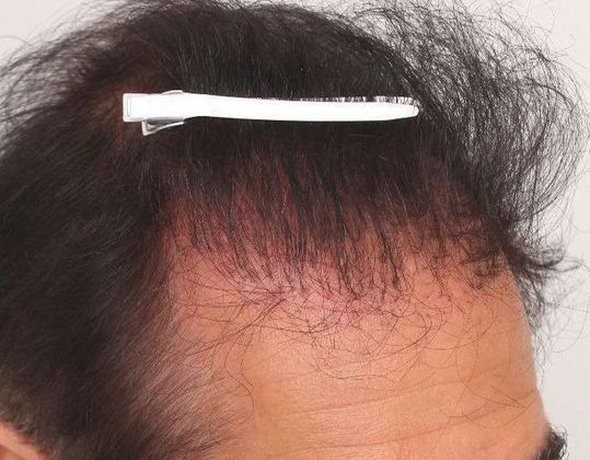 Male Before And After Hair Transplant Photos Hair Transplant Repair (2) - Before