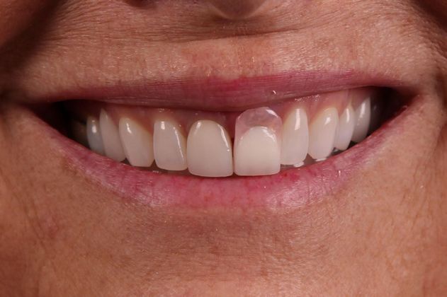 Dental Implants: Case 10 - Before