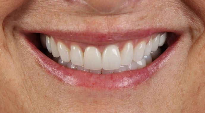 Dental Implants: Case 10 - After