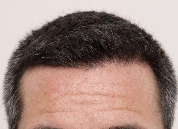 Hair Transplant - Male: Front & Top FUE - Case 30 - After FUE hair transplant