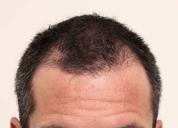Hair Transplant - Male: Front & Top FUE - Case 30 - Before FUE hair transplant