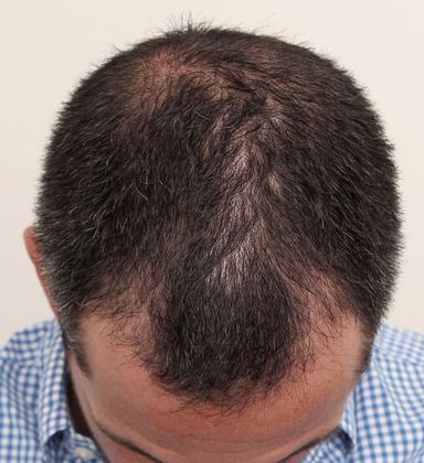 Hair Transplant - Male: Front & Top FUE - Case 30 - Before FUE hair transplant