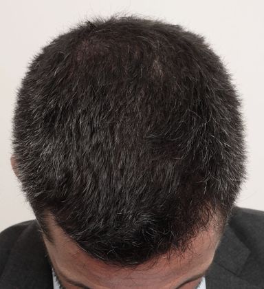 Hair Transplant - Male: Front & Top FUE - Case 30 - After FUE hair transplant