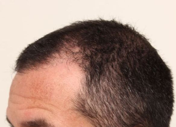 Hair Transplant - Male: Front & Top FUE - Case 30 - Before FUE hair transplant