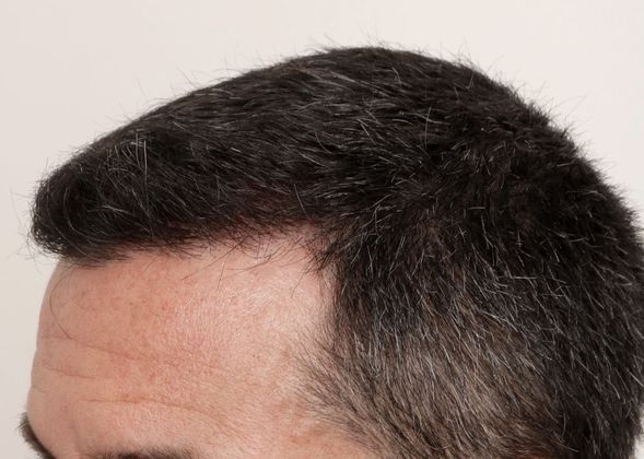 Hair Transplant - Male: Front & Top FUE - Case 30 - After FUE hair transplant