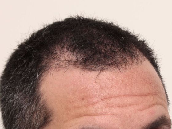 Male Before And After Hair Transplant Photos Front & Top FUE - Before