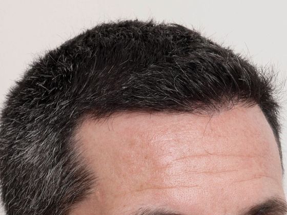 Male Before And After Hair Transplant Photos Front & Top FUE - After
