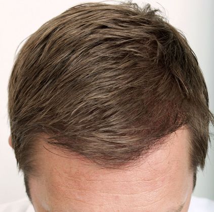 Hair Transplant - Male: Hairline FUE - Case 14 - After FUE hair transplant