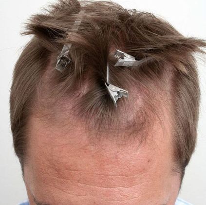 Hair Transplant - Male: Hairline FUE - Case 14 - Before FUE hair transplant