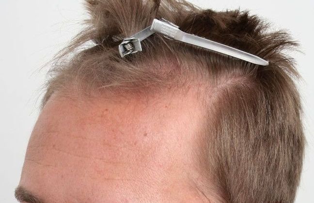 Hair Transplant - Male: Hairline FUE - Case 14 - Before FUE hair transplant