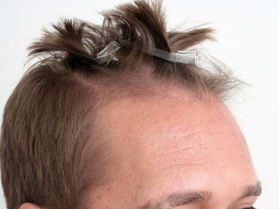 Male Before And After Hair Transplant Photos Hairline FUE (14) - Before