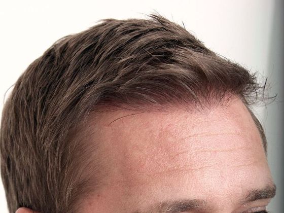 Male Before And After Hair Transplant Photos Hairline FUE (14) - After