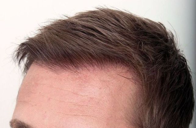 Hair Transplant - Male: Hairline FUE - Case 14 - After FUE hair transplant