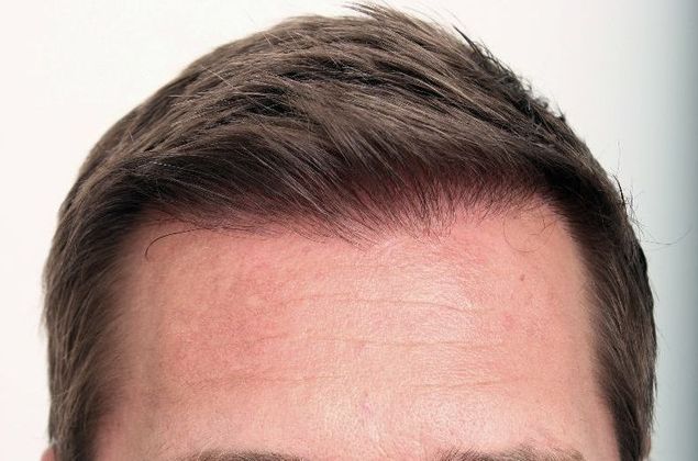 Hair Transplant - Male: Hairline FUE - Case 14 - After FUE hair transplant