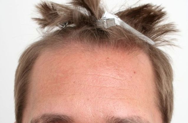 Hair Transplant - Male: Hairline FUE - Case 14 - Before FUE hair transplant