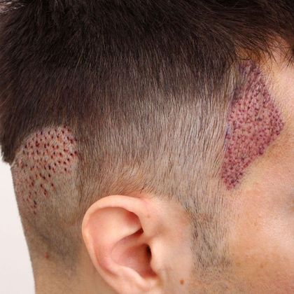 Male Before And After Hair Transplant Photos Temple peak FUE - Before