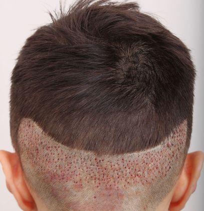 best fue hair transplant nyc - Male Before And After Hair Transplant Photos  - Before and After Gallery