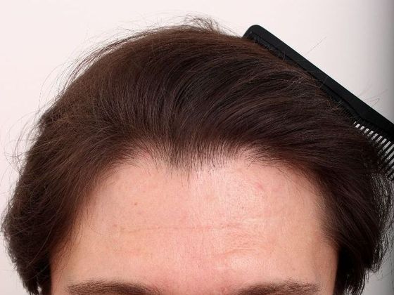 Hair Transplant - Male: Front Peak FUT - Case 32 - After FUT hair transplant