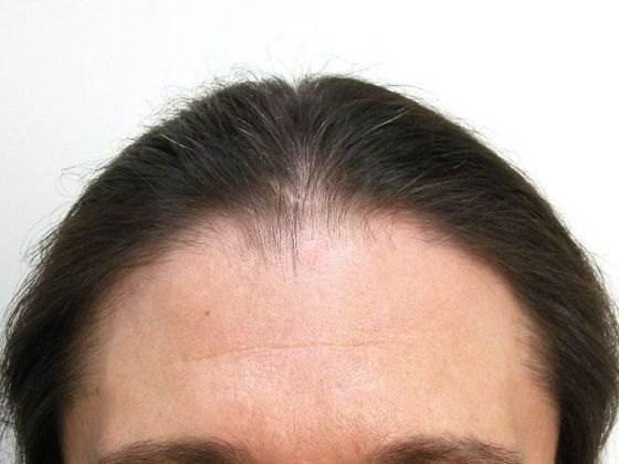 Hair Transplant - Male: Front Peak FUT - Case 32 - Before FUT hair transplant