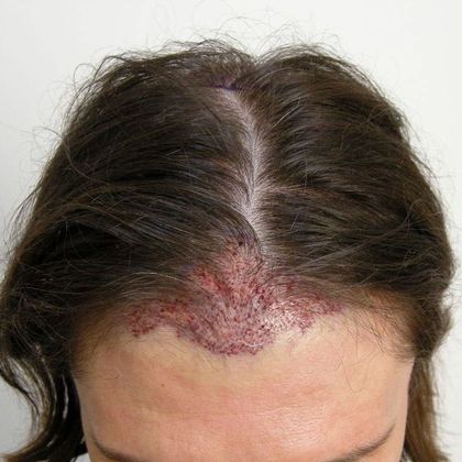Hair Transplant - Male: Front Peak FUT - Case 32 - Post-op FUT hair transplant