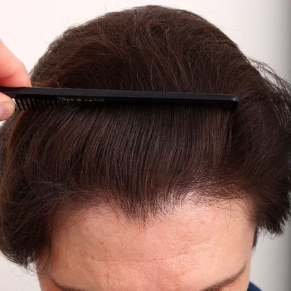 Male Before And After Hair Transplant Photos Frontal Peak FUT - After